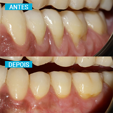 Antes e Depois 14
