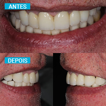 Antes e Depois 11