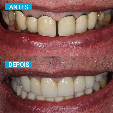Antes e Depois 5