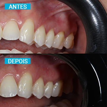 Antes e Depois 13