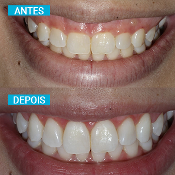 Antes e Depois 9
