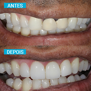 Antes e Depois 15