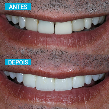 Antes e Depois 16