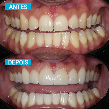 Antes e Depois 18