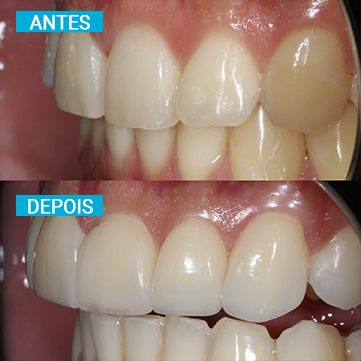 Antes e Depois 19