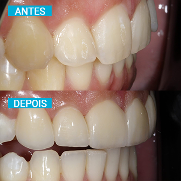 Antes e Depois 20