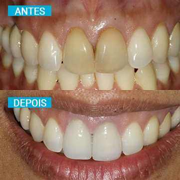 Antes e Depois 3