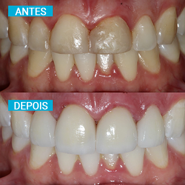 Antes e Depois 4