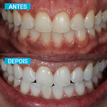 Antes e Depois 12