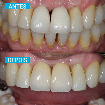 Antes e Depois 6