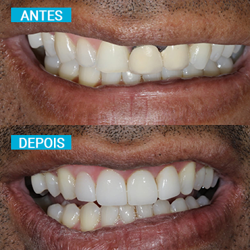 Antes e Depois 7