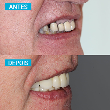 Antes e Depois 1