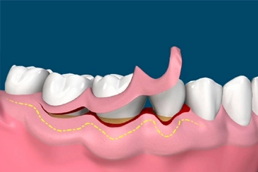 Cirurgias Periodontais