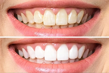 Clareamento Dentário