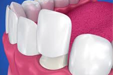 Facetas Dentárias