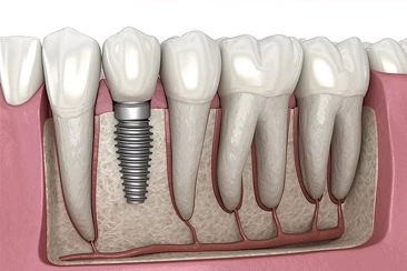 Implantes Dentários